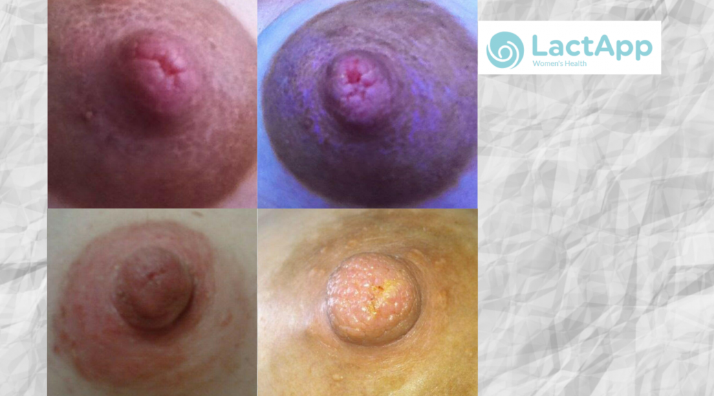 Extremely Sore Nipples? Nipples Changing Colour After