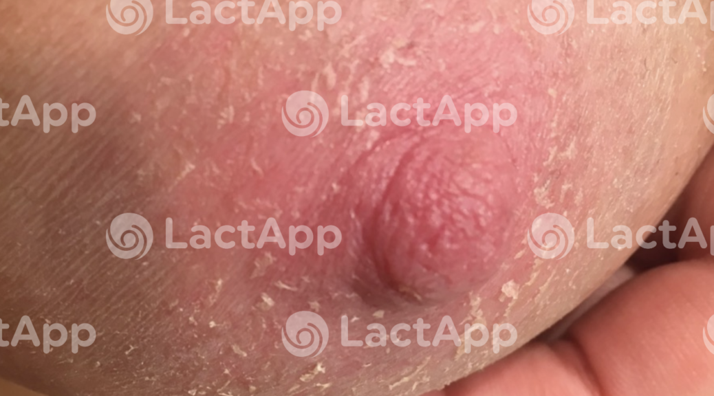 Problemas dermatológicos durante la lactancia materna