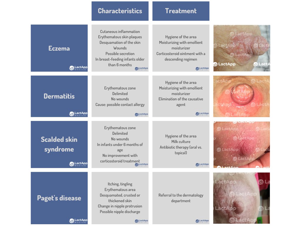 Differential diagnosis of breast and nipple pain in lactation