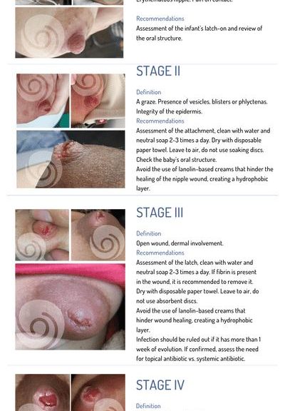 Stages of Nipple Damage - LactApp Medical Lactation