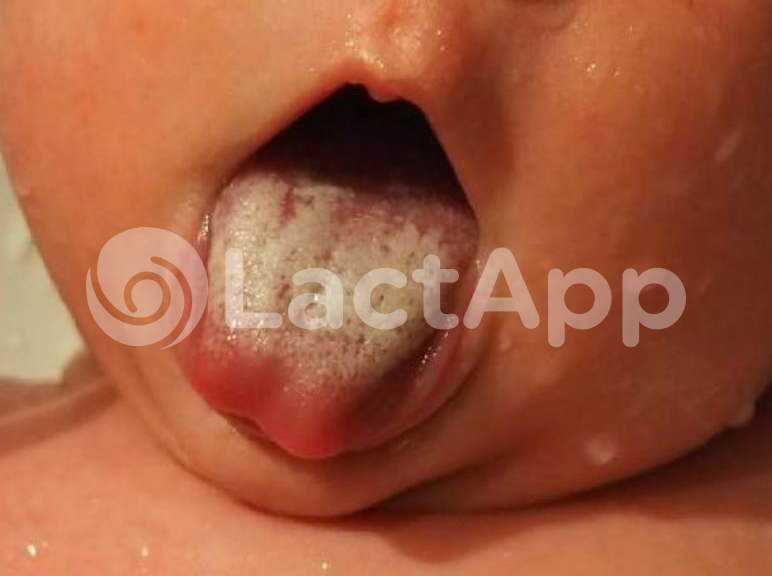 bebé lengua blanca, muguet, candida