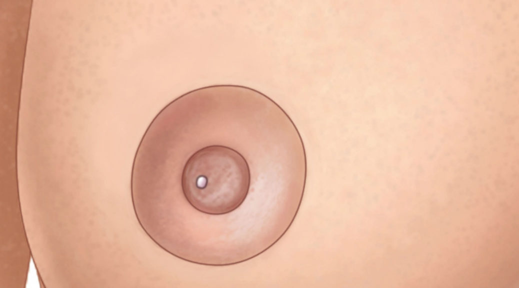 Blebs, spots, or milk blisters on the nipple